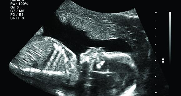 Baby death in the UK, stillbirth, neonatal death